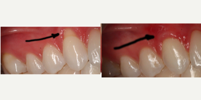 25-34 year old woman treated with Dental Bone Graft - Sensitive exposed root area was covered by a gum graft.