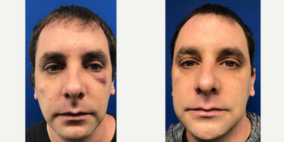 35-44 year old man treated with Laser Treatment - Excision in combination with Venus Viva laser treatment to eliminate this man's cyst on his face.