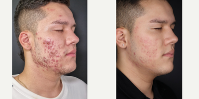 18-24 year old man treated with Scar Removal, CO2 Laser, Fraxel Laser, Microneedling RF, Chemical Peel, HydraFacial - This patient underwent a combination treatment in which we used in his first stage Hydrafacial and chemical peel with Acnelan peel, and later on one session of CO2 fractional laser and microoneedle RF