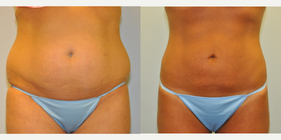 35-44 year old woman treated with SAFELipo - 40 year old female 1 year after SafeLipo of the abdomen, flanks and back.
