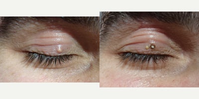 35-44 year old man treated with Cyst Removal from upper eyelid - 35-44 year old man treated with Cyst Removal by Plasma coagulation from upper eyelid