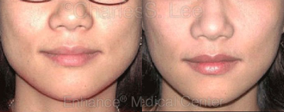 Jaw - 	Non-surgical Jaw Reduction