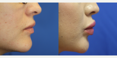25-34 year old woman treated with Lip Implants - This patient in her mid-twenties desired plumper lips. She didn't want to return to the office every 8 months for lip fillers, so she opted for the Permalip permanent lip implant. The procedure took around 30 minutes and she now has the perfect pout.