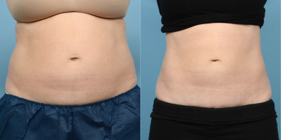 25-34 year old woman treated with CoolSculpting - This 34-year-old patient received CoolSculpting on her upper and lower abdomen, as well as her flanks. At her 3-month follow-up visit.