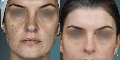 35-44 Years Old Woman Treated with Mole Removal - Moles, which occur on the face and forehead zones; picture of our female patient, whose face was completely cleaned and renewed; it is available in the appendix.