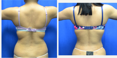25-34 year old woman treated with Vaser Liposuction - 25 year old female 6 weeks after vaser liposuction to her upper and lower back. She is 5 feet 1 inches and her weight is 123 lbs. She has two children. 1650cc's was removed from her back. As expected, the lower back has responded quickly and the upper back will improve in the next few months as the skin shrinks back. Two incisions used in the lower back and two used in the upper back below the bra strap.