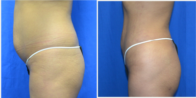 25-34 year old woman treated with Vaser Liposuction - 25 year old female 6 weeks after vaser liposuction to her abdomen and upper and lower back. She is 5 feet 1 inches and her weight is 123 lbs. She has two children. 1650cc's was removed from her upper/lower back and 1250cc's from her abdomen.