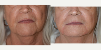55-64 year old woman treated with Restylane Refyne - The corners of the mouth can droop with time & create an unwanted 'frown'.  Immediately following injection of hyaluronic gel filler, these depressions are softer, creating a 'friendlier' appearance.