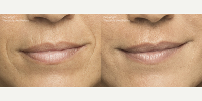 Belotero for Nasolabial Folds - This 45-year-old female patient was concerned with the fine lines and wrinkles around her mouth. Dr. Rivkin injected Belotero to smooth out and fill in her moderate-to-severe nasolabial folds.