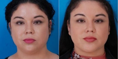 35-44 year old woman treated with Chin Implant - Procedure: chin augmentation and submental lipectomy.