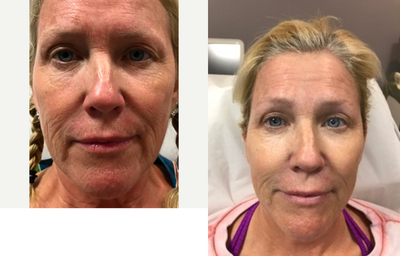 45-54 year old woman treated with Vampire Facelift - Vampire Facelift is a trademarked procedure that incorporates a filler with PRP. We are using Bellafill because of the significantly increased longevity and collagen stimulation compared to HA fillers. We also use a large volume PRP kit to maximize results. Even with one syringe of Bellafill, we can get results like these. A full Vampire facelift could involve 5 or more syringes of filler.