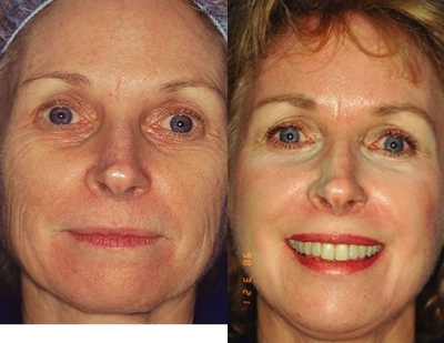 Fractional CO2 Laser Treatment - 
	uses a Fractional CO2 laser treatment to improve and rejuvenate the appearance of the patient&#39;s skin.
