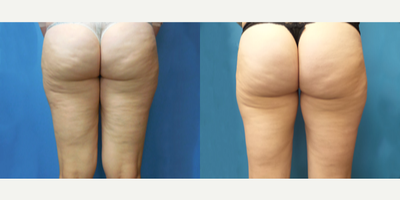 41 year old woman treated with Velashape - This patient had 4 Velashape treatments on the buttocks and thighs