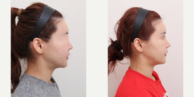 25-34 year old woman treated with AccuLift, Liposuction - 33 Years old female patientChief Complaint:Facial puffiness and uneven contour, especially in the lower cheeks and jawline.Treatment Plan:Facial liposuction focusing on lower cheeks and jawline refinement.Outcome:Slimmer, more defined facial contour with reduced puffiness and improved facial balance.