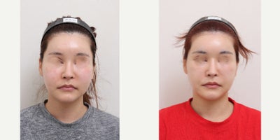 25-34 year old woman treated with AccuLift, Liposuction - 33 Years old female patientChief Complaint:Facial puffiness and uneven contour, especially in the lower cheeks and jawline.Treatment Plan:Facial liposuction focusing on lower cheeks and jawline refinement.Outcome:Slimmer, more defined facial contour with reduced puffiness and improved facial balance.