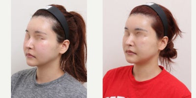 25-34 year old woman treated with AccuLift, Liposuction - 33 Years old female patientChief Complaint:Facial puffiness and uneven contour, especially in the lower cheeks and jawline.Treatment Plan:Facial liposuction focusing on lower cheeks and jawline refinement.Outcome:Slimmer, more defined facial contour with reduced puffiness and improved facial balance.