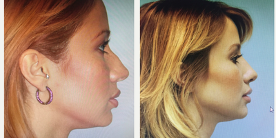 18-24 year old woman treated with Rhinoplasty - 24 year old woman treated with a closed rhinoplasty (no external scars)