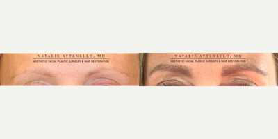 Eyebrow Transplant - This patient was tired of drawing in her eyebrows everyday and wanted to restore her natural eyebrows. This is her four months after an eyebrow transplant and the transplanted hairs will continue to grow.