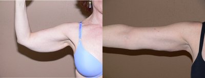 55-64 year old woman treated with Arm Lift - Arm Lift