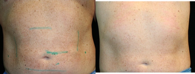 35-44 year old man treated with UltraShape - 6 weeks after 3 combination treatments of UltraShape and Vela3.