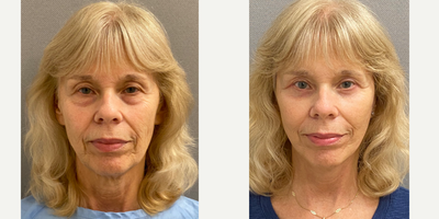 65-74 year old woman treated with Facelift, Neck Lift, SMAS Facelift - 66 yo s/p facelift, neck lift with lower blepharoplasty with skin pinch performed under local anesthesia with sedation in our on site AAAA Certified operating suite.