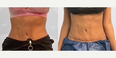 35-44 year old woman treated with Emsculpt - This woman in her mid-thirties had a previous tummy tuck elsewhere and was unhappy with her results.  Dr. Tucker performed her tummy tuck revision, which she was very happy with.  To maintain her results and smooth out her upper abdomen area he recommended four sessions of Emsculpt Neo.  Our body contouring specialist, Jessica administered her treatments, and she looks great pictured before and after her treatment package.