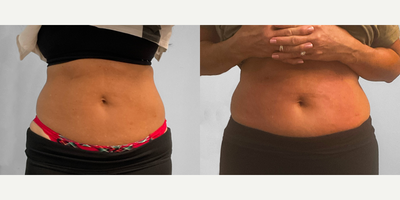 55-64 year old woman treated with Emsculpt - This woman in her late fifties was interested in Emsculpt Neo for body contouring her abdomen.  She chose to proceed with four sessions in one month with our body contouring specialist Jessica.  She has been very happy with her results and lost an inch around her waist throughout the process.  She looks great and is pictured before and three months after completing her package.