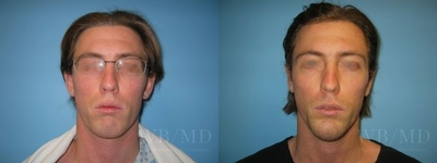 26 year old man treated with Chin Surgery - 26 year old man after silicone chin implant.