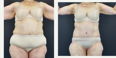 65-74 year old woman treated with Lipedema Surgery, Liposuction - This lovely patient was treated with circumferential 360 liposuction to her torso to treat her Lipedema.