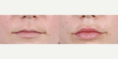 Woman treated with Lip Fillers - Woman treated with Lip Fillers
