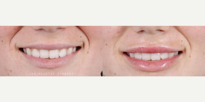 Woman treated with Lip Fillers - Woman treated with Lip Fillers