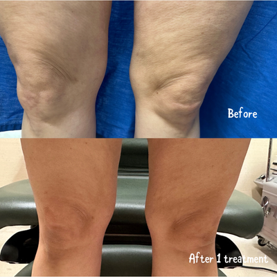 55-64 year old woman treated with truSculpt - 55-64 year old woman treated with truSculpt