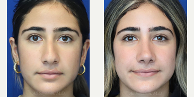 Woman treated with Rhinoplasty - Rhinoplasty