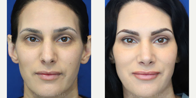 Woman treated with Rhinoplasty - Rhinoplasty