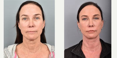 55-64 year old woman treated with Eyelid Surgery, Fractional Laser, Mini Facelift, Neck Lift - This patient received an upper blepharoplasty. She also received fractional CO2 laser to her face, neck and chest. She also received a lip lift procedure.