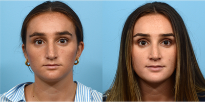 18-24 year old woman treated with Septoplasty - Rhino and septoplasty