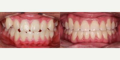 Teen with an Underbite - Age: 11 - 17Gender: MaleProcedure: Clear Ceramic BracesThis teen patient came in with an underbite. The dentist treated him with Clear/Ceramic braces, and he completed his treatment in 24 months (original estimate 24-30).