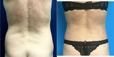 55-64 year old woman treated with Liposuction - 57 year old female who had liposuction of the abdomen, hips and back