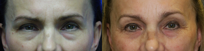 35-44 year old woman treated with Eyelid Surgery - Endobrow lift with upper and lower blepharoplasty. Result after 2 months and after 17 years. Results after many years of facial rejuvenation surgeries hold up well despite sun damage. It is important to always wear sunscreen!