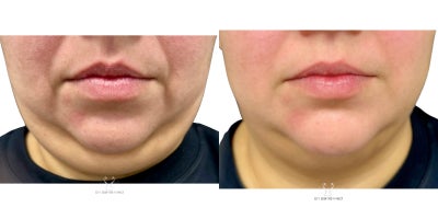 35-44 year old woman treated with Skin Tightening, Endolift - Full face slimming and lower face contouring.