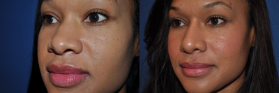 33 year-old female Rhinoplasty - 
	33 year-old female underwent rhinoplasty surgery.
