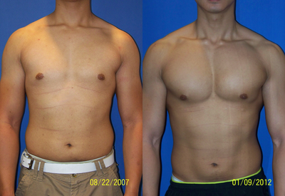 5 years after Pec Implants and Liposculpture - Patient before and 5 years after vertical-rectangular pectoral implants were placed under the muscle as well as having liposculpture of the waist.