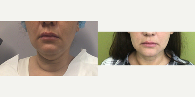 25-34 year old woman treated with Tickle Lipo - submental liposuction