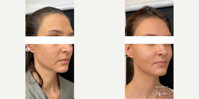 Woman treated with Renuva - Woman treated with Renuva