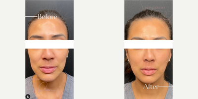 Woman treated with Renuva - Woman treated with Renuva
