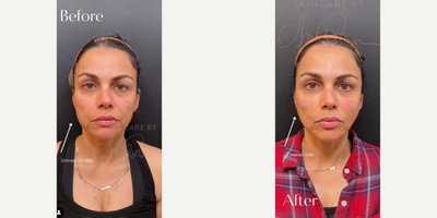 Woman treated with Renuva - Woman treated with Renuva