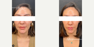 Woman treated with Renuva - Woman treated with Renuva