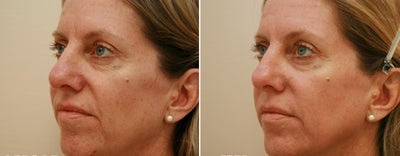 Female treated with c02 fractionated laser (Mixto) - MiXto c02 fractionated laser used to treat sun damaged skin. Patient saw an overall improvement in skin tone and texture.
