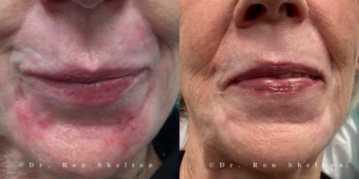 75 and up year old woman treated with Scar Removal, Vbeam - This 84 year old woman did have two keloid scars on the chin that developed a few months after the laser and were treated by multiple Vbeam pulsed dye laser sessions and corticosteroid injections with a very good result.