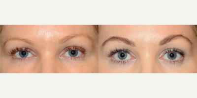 35-44 year old woman treated with Microblading - Microblading treatment of the eyebrows.